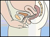 Nuvaring sistema de liberacion vaginal-figura6